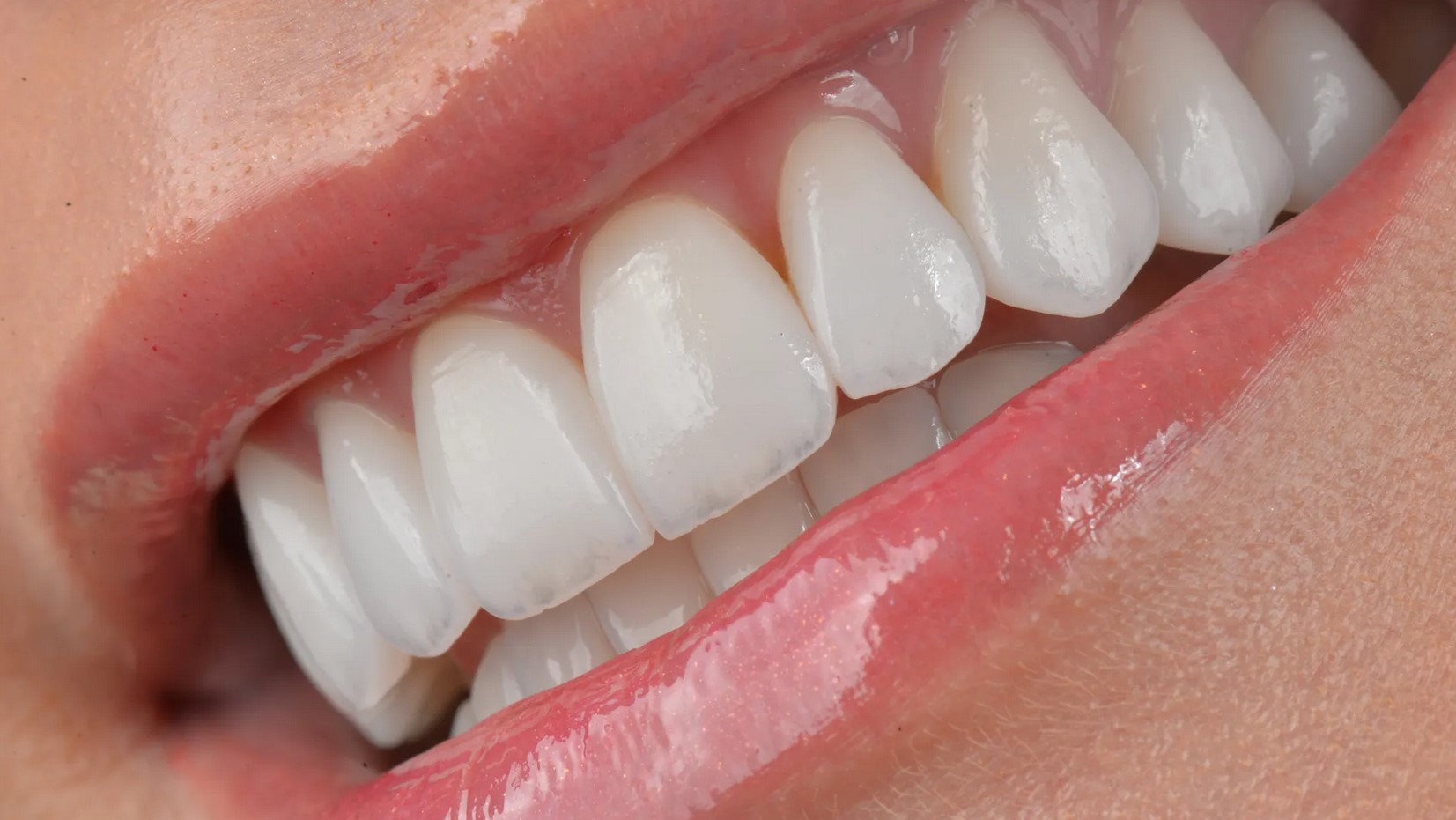 Lentes de Contato Dental