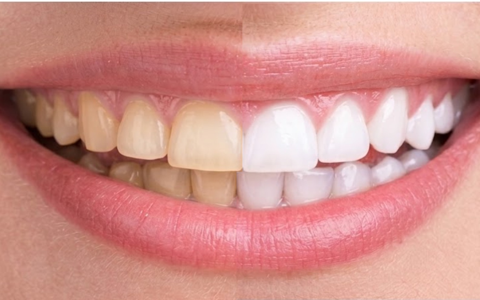 Clareamento Dental
